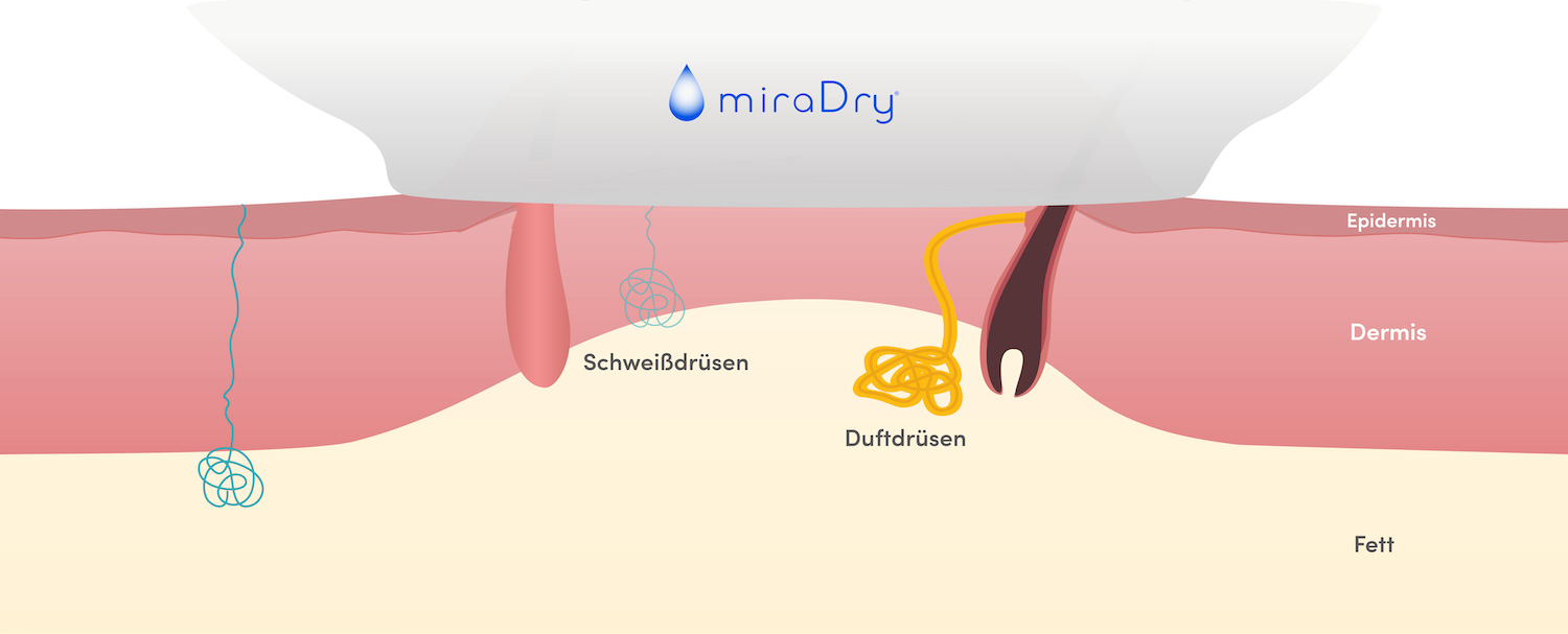 Step 2 miraDry-Behandlung